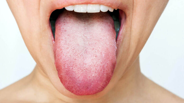 Tongue Problems
