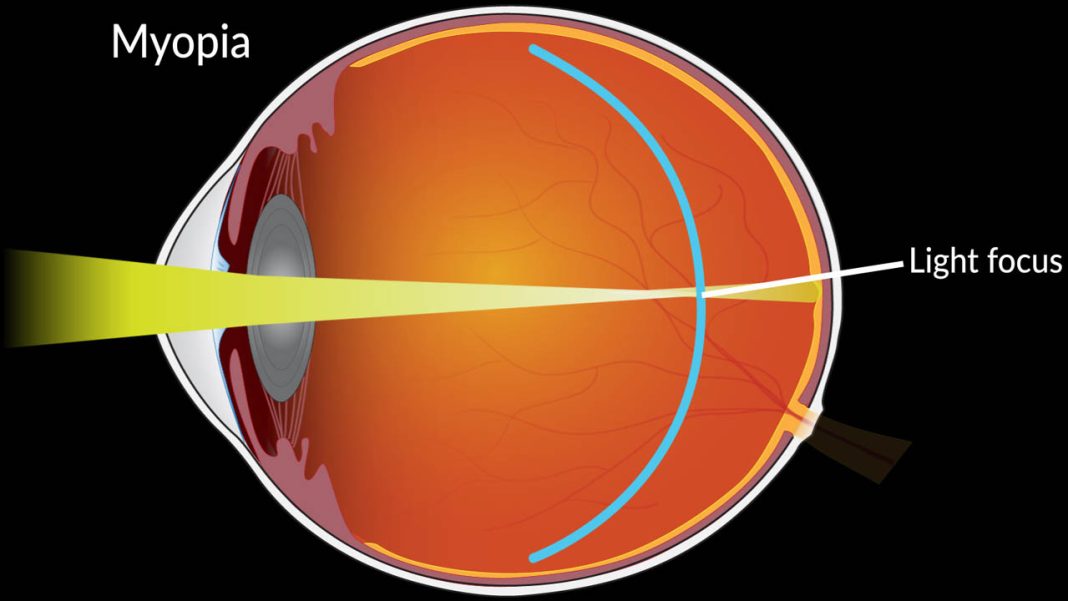 Children Eyesight | పిల్లల చేతిలో స్మార్ట్‌ఫోన్.. వేగంగా పెరుగుతున్న మయోపియా
