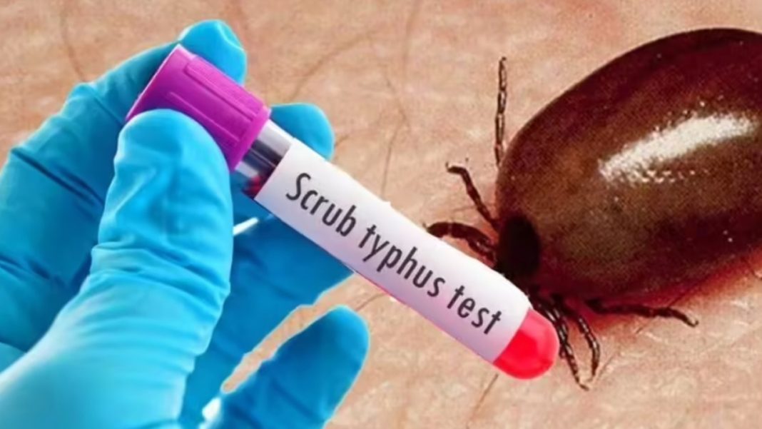 Scrub Typhus