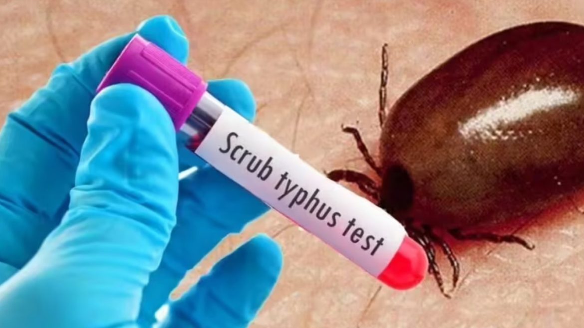 Scrub Typhus