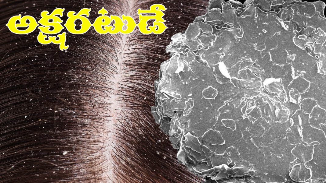 Dandruff | చుండ్రుతో చింతేలా.. ఇంట్లోనే చికిత్స ఉందిగా..!