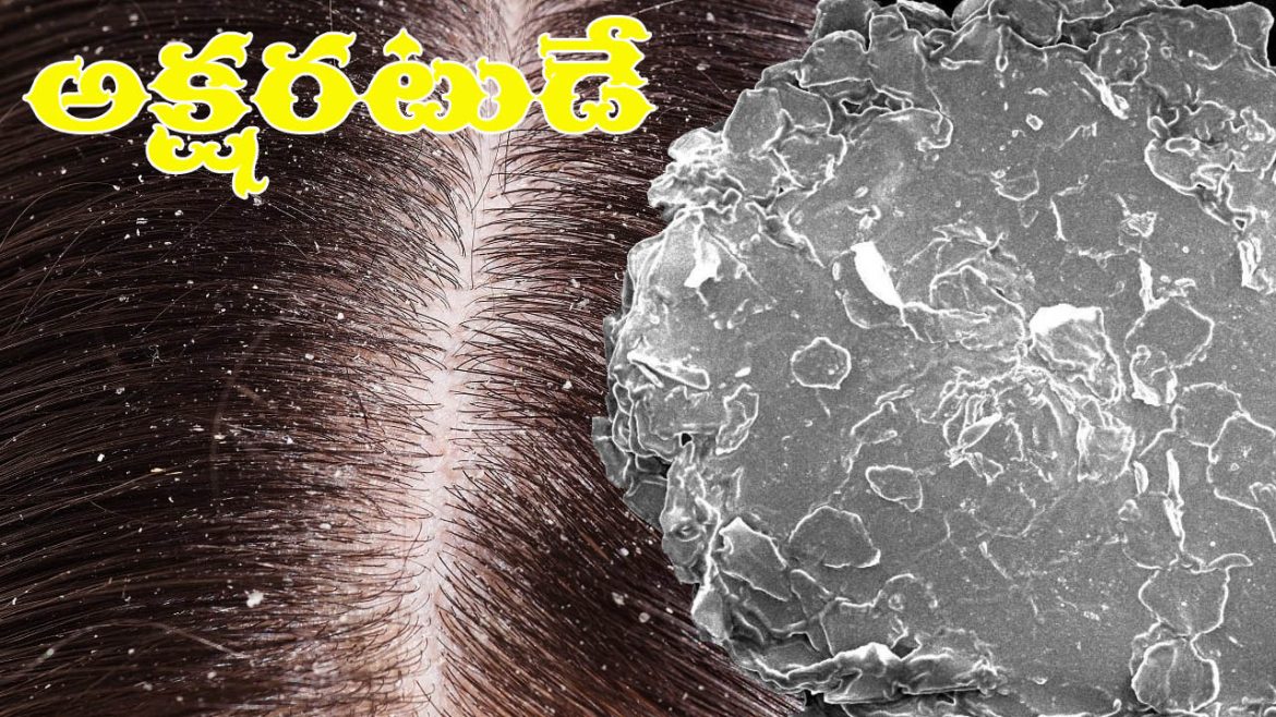 Dandruff | చుండ్రుతో చింతేలా.. ఇంట్లోనే చికిత్స ఉందిగా..!