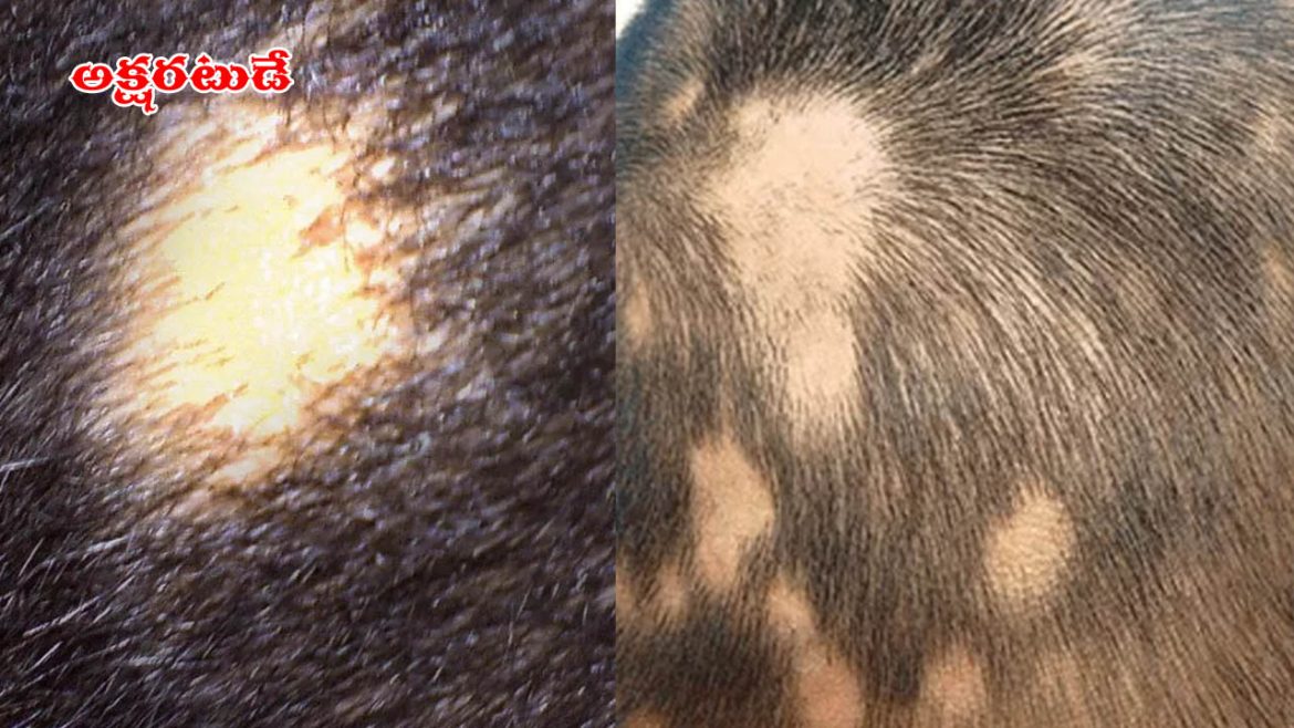Hair Fall | తలపై జుట్టు రాలుతోందా.. గుండ్రటి మచ్చలు సైతం ఏర్పడుతున్నాయా.. అది అలోపేసియా అరేటా కావొచ్చు.. జాగ్రత్త సుమా!